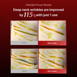 Meditherapy Collagen Wrinkle-fit Neck Mask Results