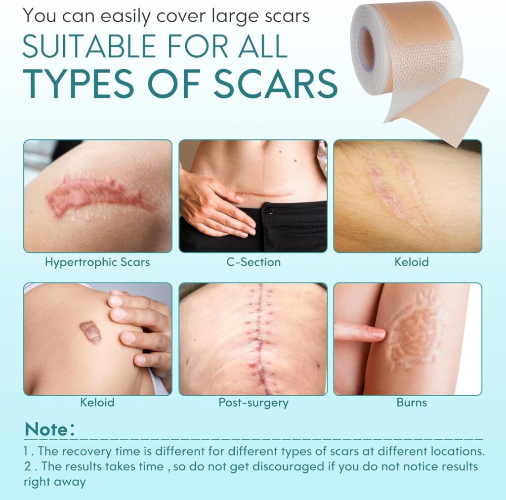 Elaimei Silicone Scar Sheets 4.6cm x 4m | Medical Grade Scar Tape ...