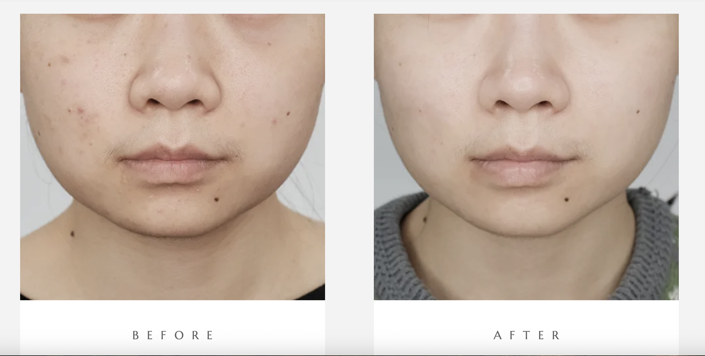 RHEA PDRN Rejuvenation Serum results